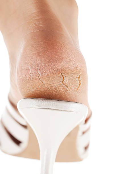 Dry and cracked sole of foot in a shoe on white background. You might also be