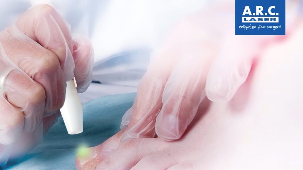 fungal nail laser